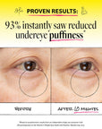 Before and after showing reduced undereye puffiness with text claiming 93% reduction.