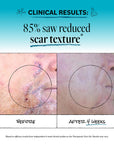 Scar Gel