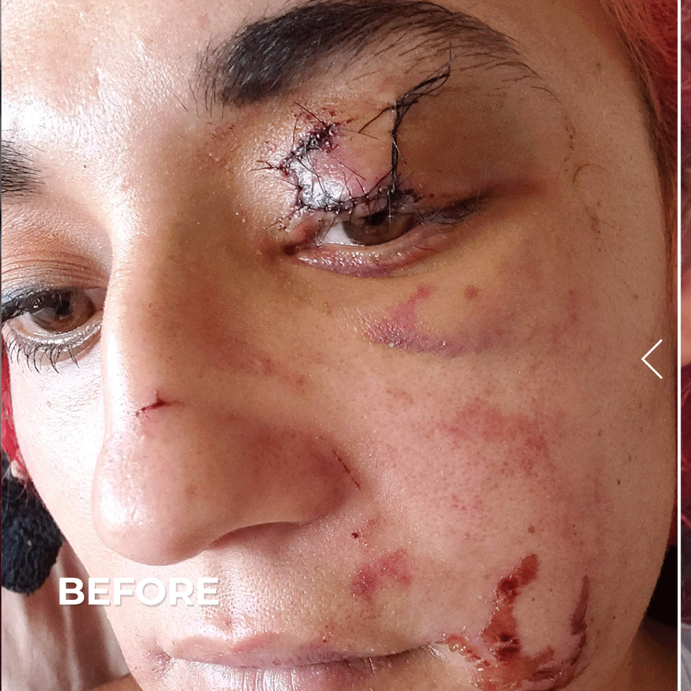 before and after photo of a woman's face scars with scar gel use