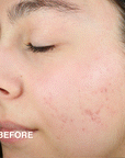 Before and After Photo of a womans face after using Derma E's Sulfur Spot Treatment