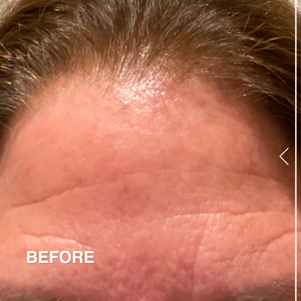 Ferulic Acid Resurfacing Pads