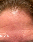 Ferulic Acid Resurfacing Pads
