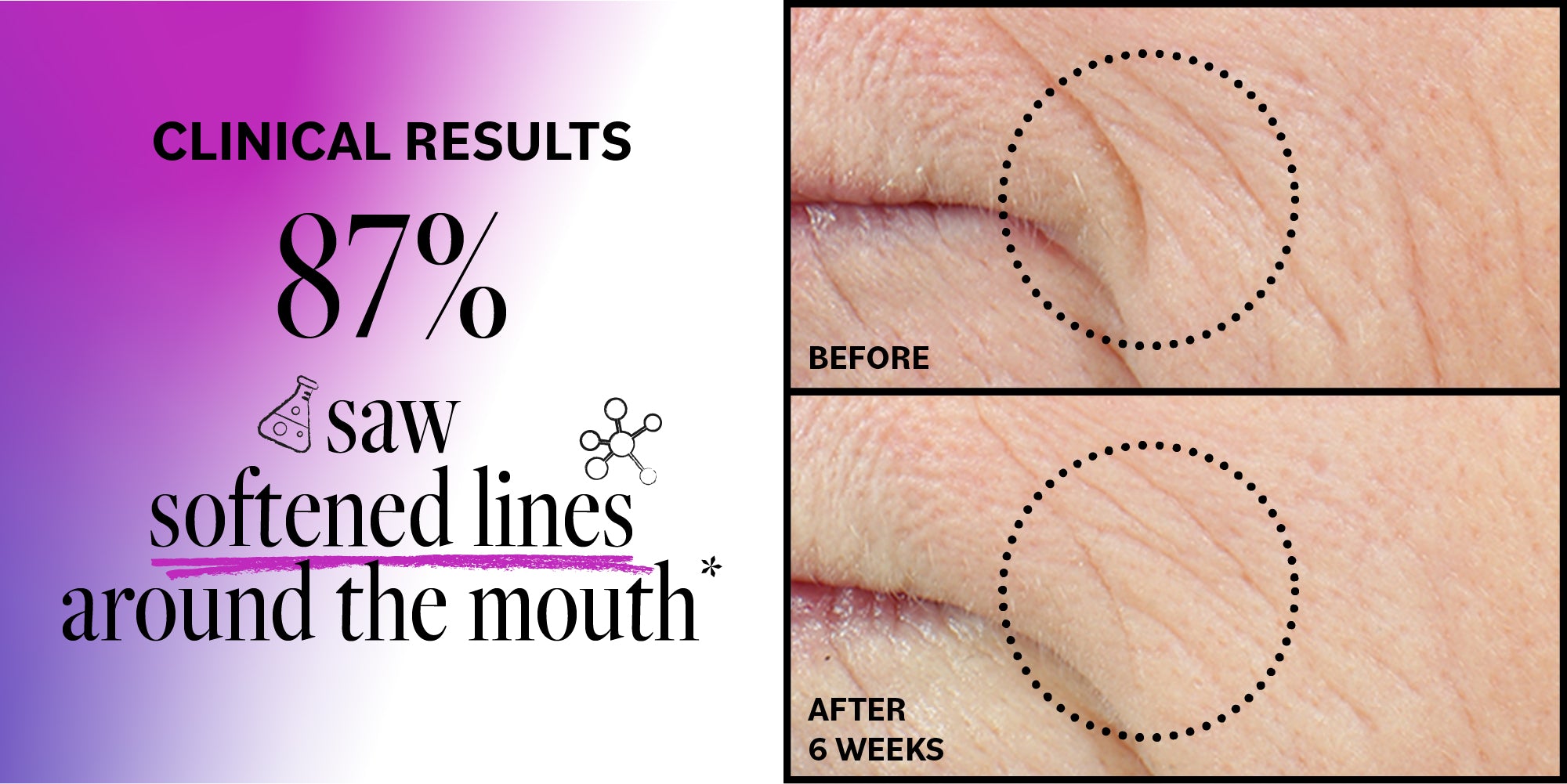 Advertisement showing clinical results of a skincare product with before and after images of mouth area.