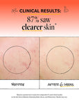 Acne Deep Pore Cleansing Wash