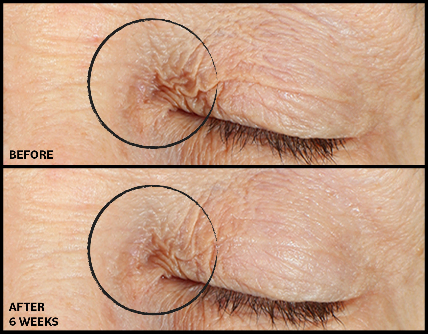 Before and after comparison of eye skin texture with a focus on wrinkles.