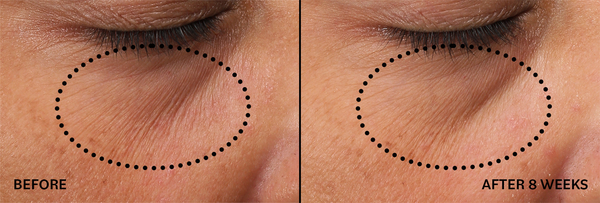Before and after comparison of eye area treatment showing reduced wrinkles.