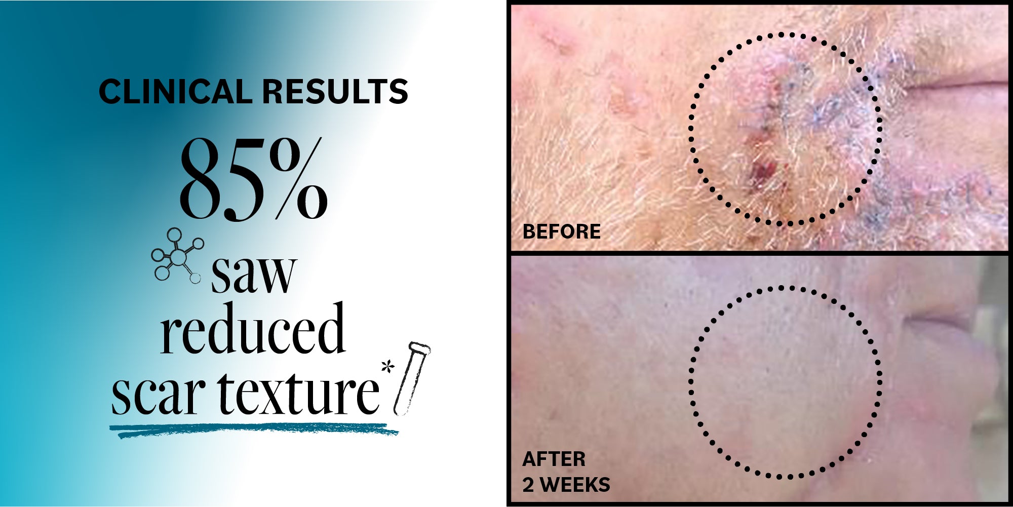 Advertisement showing clinical results of a skincare product with 'Before' and 'After' images of scar texture reduction.