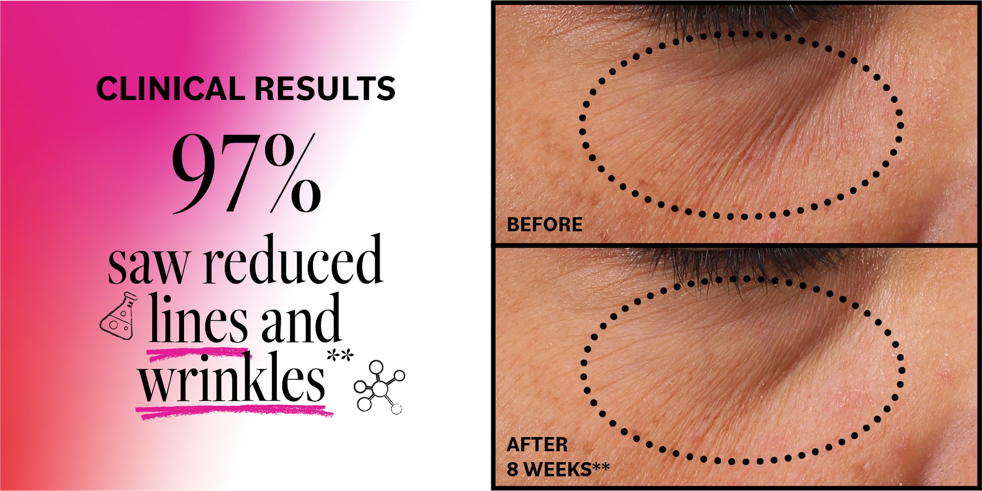 Advertisement showing clinical results of reduced lines and wrinkles with before and after images.