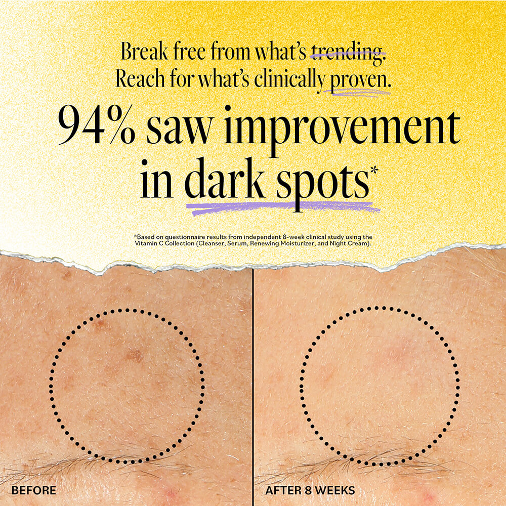 Before and after 8 weeks of using DERMA E Vitamin C Concentrated Serum. 94% saw improvement in dark spots.