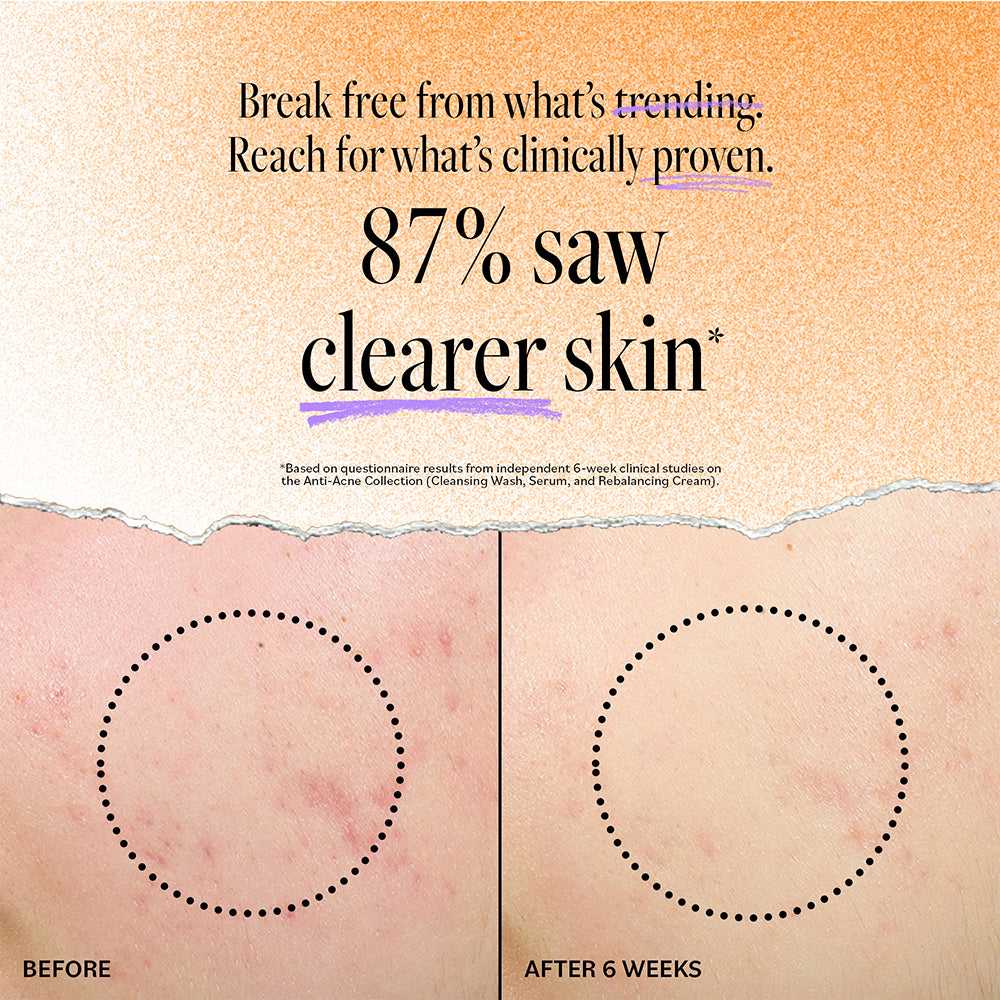 Acne Treatment Serum for Blemish Control