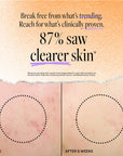 Acne Treatment Serum for Blemish Control