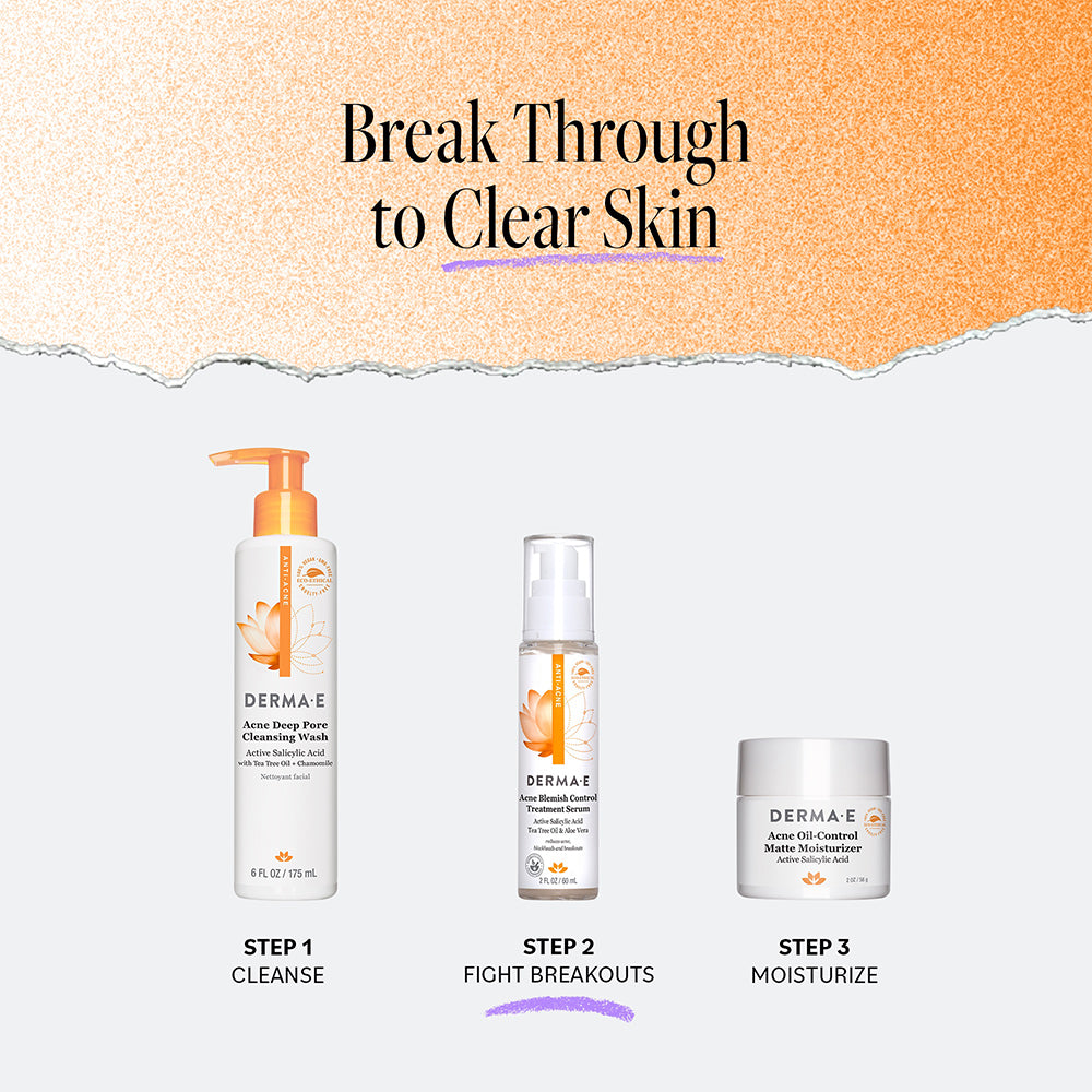 Acne Treatment Serum for Blemish Control