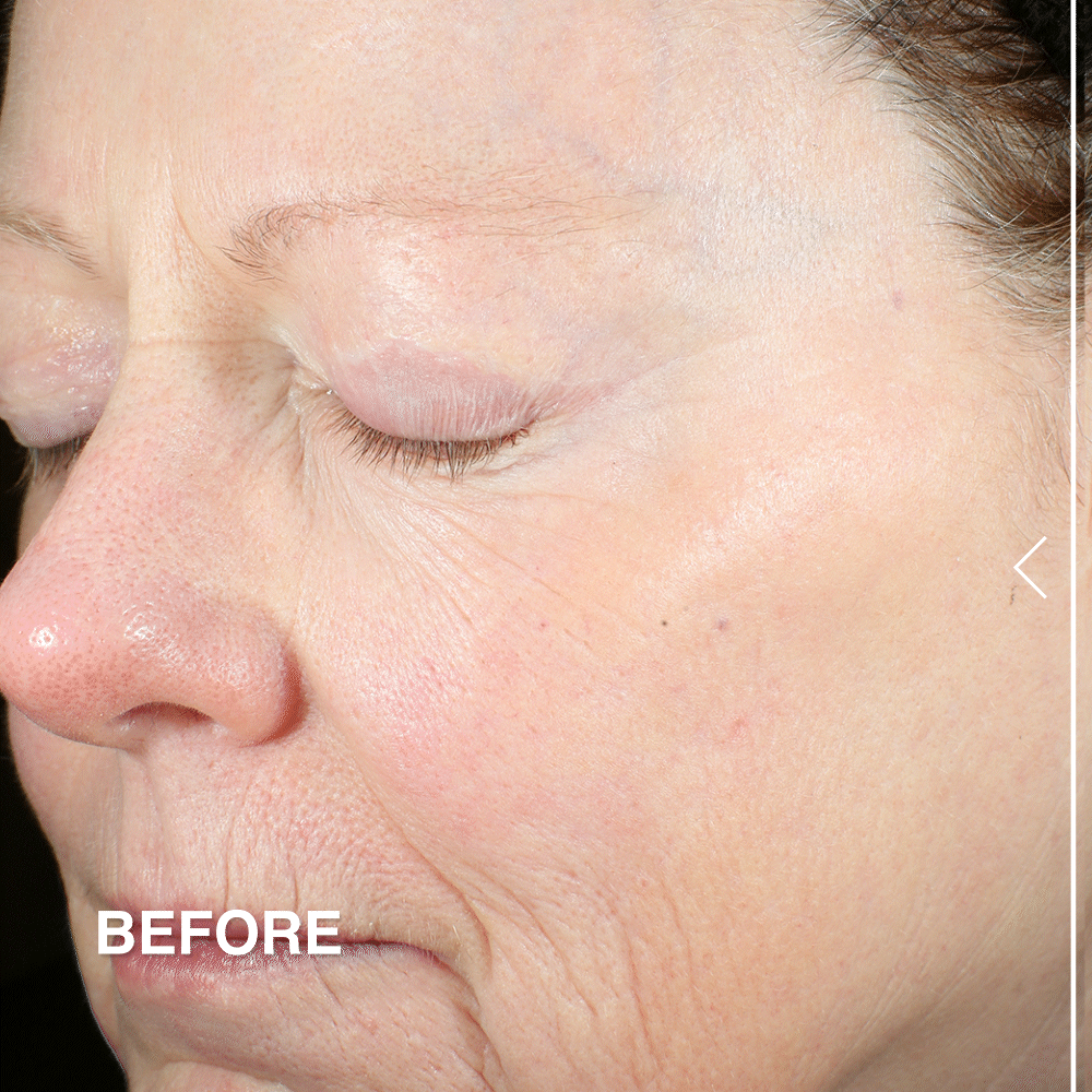 Advanced Peptides &amp; Flora-Collagen™ Cryo-Gel Mask